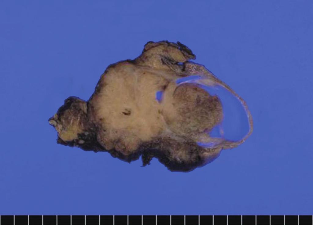 In the cystic area of the tumor, an intracystic papillary-growing pattern was noted (Fig. 2A).