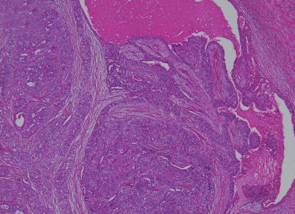 (A) The tumor is composed of papillary and solid proliferative components and has a focally