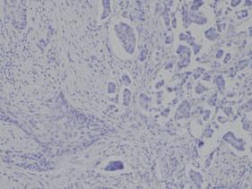 for CK20. Immunohistochemical staining for D2-40 highlighted the lymph vessel invasion of tumor cells in part.