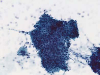 HPV+ Squamous Cell Carcinoma Metastatic HPV+