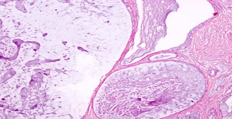 Mucoepidermoid Carcinoma Cytologic Features: 3 Cell Types: Mucus, epidermoid, and intermediate