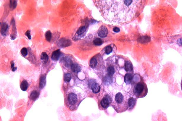 Mammary Analogue Secretory Carcinoma Analogous to secretory carcinoma of breast Previously