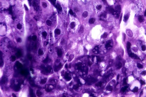 Acinic Cell Carcinoma Second most common salivary gland malignancy 2-6% of all salivary gland neoplasms Low-grade malignancy : Recapitulates growth of normal acinar cells F>M, 90% parotid Histology