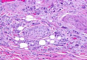 comedo-type breast carcinoma Androgen receptor +, Her2neu +,