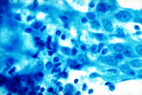 plasma cells Germinal center fragments Tingible body macrophages