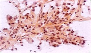 Carcinoma Papillary-Cystic