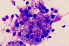 oncocytic metaplasia Mucoepidermoid