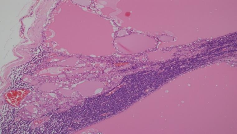 Secretory carcinoma Often lobules with thin septae Tubular, solid, microcystic,
