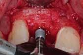 Treatment planning to replace the maxillary missing tooth utilizing an autogenous bone graft and dental implant was discussed, and the alternative option of using the xenograft bone blocks (OsteoBiol