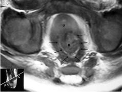 Result of Pelvic MRI: In 21/24 patients the rectum was centralized in the three levels of transverse sections at levator ani, muscle complex, and external anal sphincter.