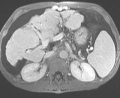 A B C Nodular cirrhotic liver in a patient with known