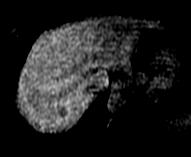 DTPA MR imaging has been found to be useful