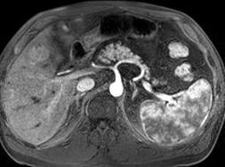 patient with rectal cancer metastases.