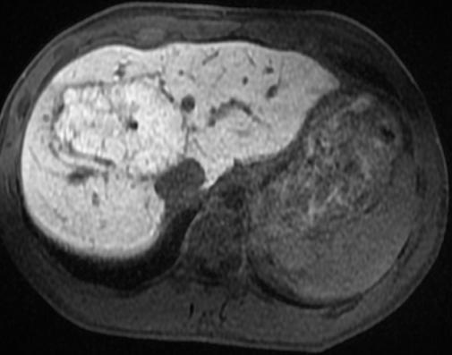 the hepatocyte phase B Lobulated mass with a central scar involving segments 7 and 8 of the liver with enhancement in the (A) arterial and portal venous (not shown)