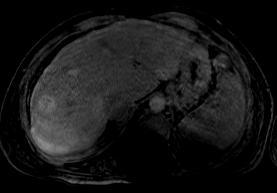 usually hypervascular, and they can mimic HCC 34 year old female with history of L-transposition