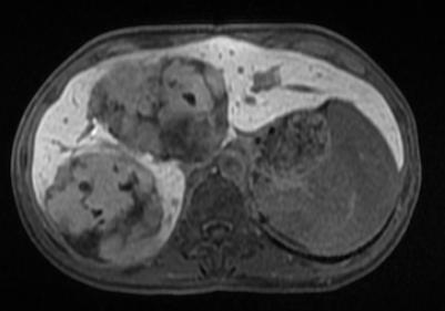 lower The plasma half-life of Gd EOB DTPA is substantially shorter B 46 year old female with liver hemangiomas.