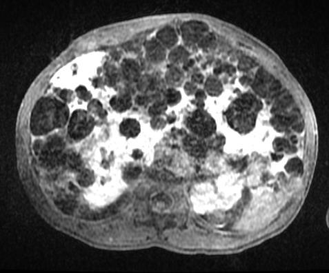administration B C Cysts appear