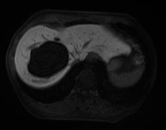 massive liver and multiple cysts and