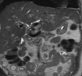 T2W portal venous B arterial hepatobiliary Degree of bile duct obstruction can be classified with delayed Gd-EOB- DTPA enhanced bile flow dynamics (>30 minutes after intravenous injection of