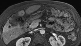 Second most common form of primary hepatobiliary malignancy A Derives from the biliary epithelium, arising as