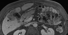 Hypointense appearance of cholangiocarcinoma on the hepatobiliary phase allows for better lesion demarcation,