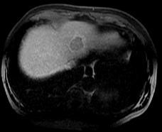 year old male with nonalcoholic fatty liver disease.
