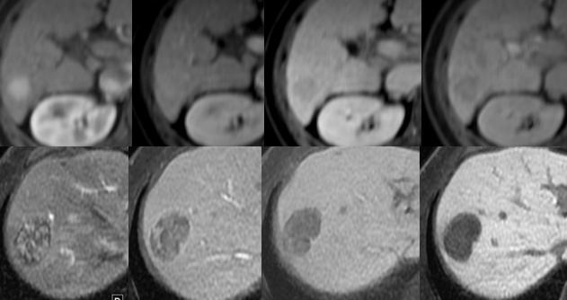 Low Grade HCC High Grade HCC A B C D Low vs High grade HCC can be distinguished by comparing: Enhancement trend on Gd-EOB-enhanced MR imaging, with higher grade lesions washing out sooner E F G H 62