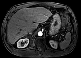 A B C Innumerable hepatic nodules show (A) mild arterial enhancement with