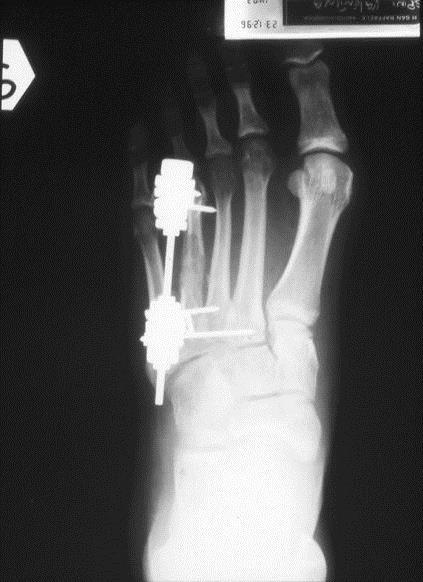 Radiograph taken during lengthening of the fourth
