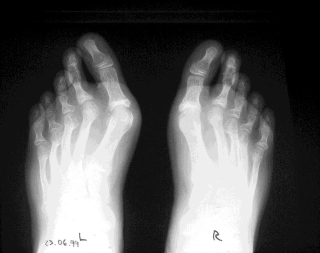 Radiograph showing the bilateral