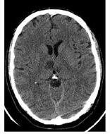 PCA stroke syndromes, cont d Thalamic infarct Contralateral sensory loss Aphasia (if