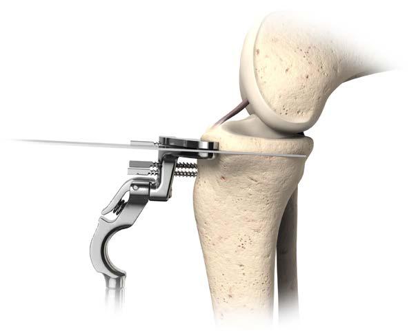 Tip: Use retractors to protect all ligaments including the collateral ligaments. Remove the resected bone.