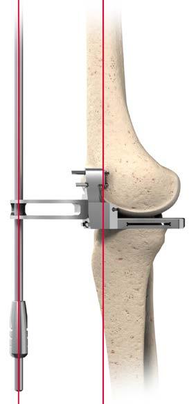 Placement and Alignment With the knee in extension, introduce the Distal Cutting Block with any attached shims into the joint space using the System Handle (Figure 23).