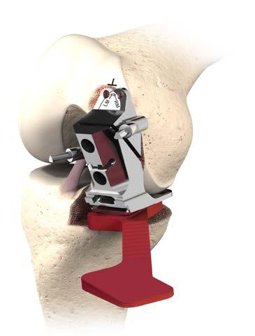 A Tibial Trial or the Femoral Spacer may be placed on the tibia to stabilize the block on the