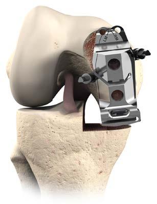 Femoral Sizing and Rotation Using the Femoral Finishing Block Secure the Femoral Finishing Block into place with pins.