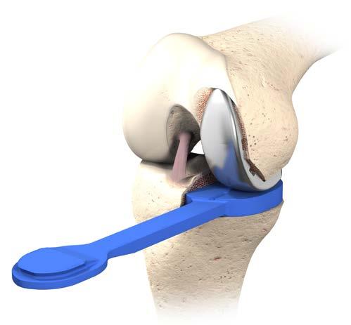 Trial Reduction Aim: Assess soft tissue balance, range of motion and component-to-component relationship in flexion and extension. Insert the selected sized Femoral Trial and Tibial Trial on the bone.