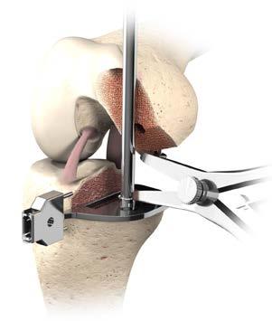 Tibial Preparation Insert the Tibial Keel Trial through the slot into the cavity to confirm adequate bone has