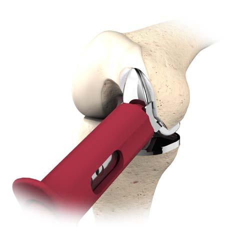 Cement Technique Femoral Component Apply an even layer of cement on the femoral prosthesis, minimizing the amount applied posteriorly (Figure 43).