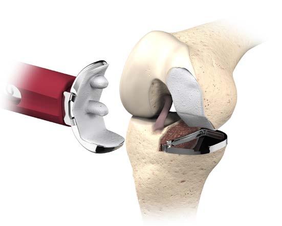 in sclerotic bone. Attach the femoral prosthesis to the Femoral Introducer. With the knee flexed to 100 110 degrees, seat the femoral prosthesis.