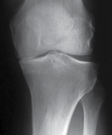 X-ray Templating Anterior/Posterior (A/P) Template: Tibia Goal: Use the A/P template to visualize and approximate the level of tibial resection to re-establish the pre-morbid articular cartilage