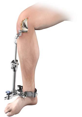 Proximal Tibial Resection Tibial Jig Alignment Aims: The Tibial Cutting Block is positioned to achieve varus/valgus alignment that is perpendicular to the mechanical axis of the tibia and for the