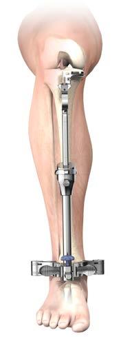A/P Slope Aim: The slope matches the patient s natural tibial slope.