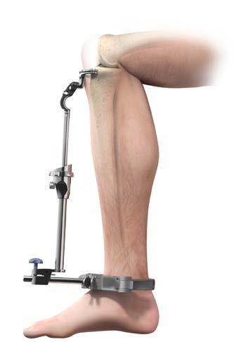 The Tibial Jig Uprod and Ankle Clamp are designed to prevent an adverse reverse slope.
