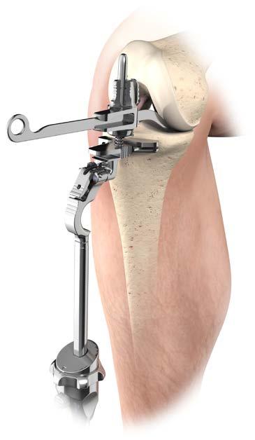 Tibial Jig Alignment Resection Level Aim: Minimum amount of resection necessary to restore the joint line.