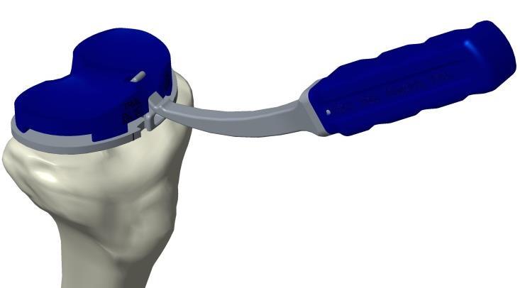 Use the Poly Trial Removal Tool to pry out the Poly Trial through the anterior removal feature.