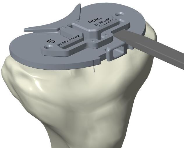 Select the appropriate Keel Punch (1-2 for Tibial Tray sizes 1 & 2, 3-6 for Tibial Tray sizes 3, 4, 5 & 6) and align the tip of the Keel Punch with the cruciform cutout in the Keel Punch Guide.