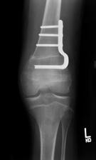 Technical Outcome Radiographic DFEO only Crouch improved, but persistent Contracture improved, but persists DFEO+PTA Crouch ROM Contracture corrected improved corrected PTA only Crouch No contracture