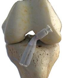 The AperFix System AFX with the Femoral Implant AM