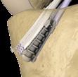 Implant AperFix II Tibial Sheath & Screw System The