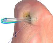 The AperFix System 14 PASSING THE TENDONS Feed the tendon sutures through the retrieval suture loop and gently pull the